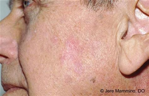 White Spots On Face Cancer