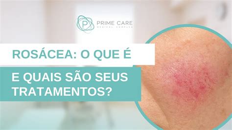 Rosácea O Que é E Como Tratar Com A Dra Paula Ferreira Dermatologista