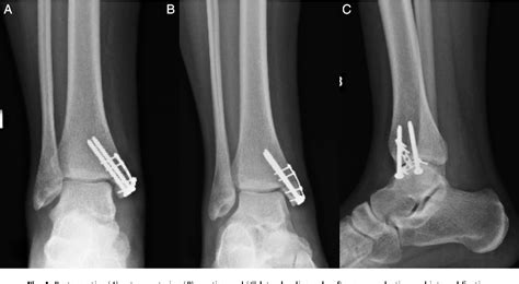 Figure 5 From Incarceration Of The Posterior Tibial Tendon In An