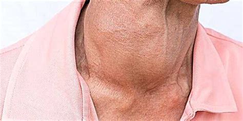 Swollen Thyroid Gland Goiter Causes Symptoms And Treatment