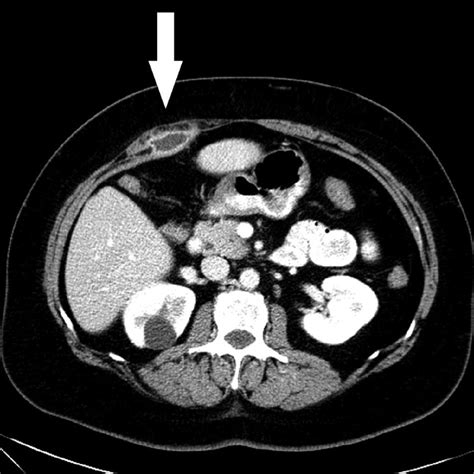 Ct Scan Shows An Abscess With Peripheral Rim Enhancement Beneath The