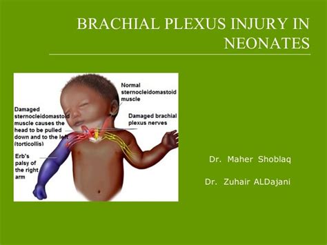 Brachial Plexus