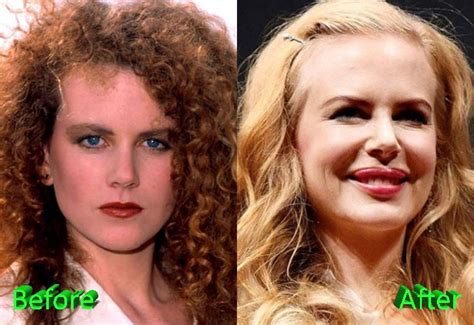 Nicole Kidman Plastic Surgery Celebrity Plastic Surgery Cirugía