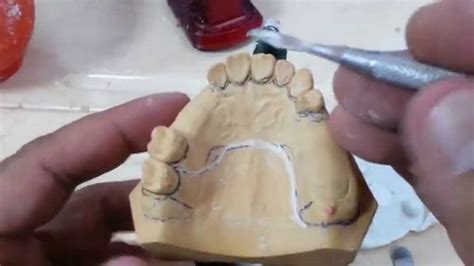Prosthodontics Laboratorylecture 4 Clasps Youtube