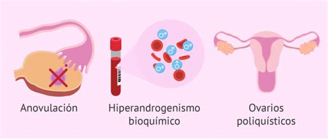 ¿cómo Se Diagnostica El Síndrome De Ovarios Poliquísticos