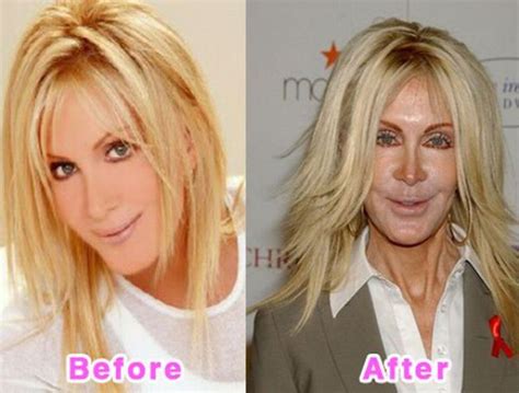 Joan Van Ark Plastic Surgery Before And After Plastic Surgery Disasters Bad Plastic