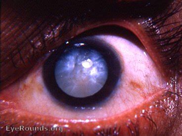 Intumescent Cataract Eyerounds Org Online Ophthalmic Atlas
