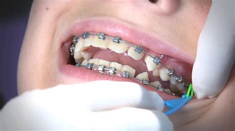 Orthodontics Limited Elastics Video Youtube