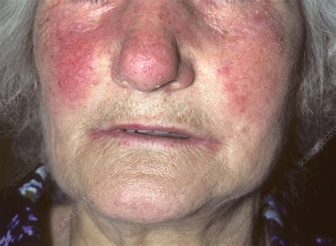 Acne Rosacea Stock Image C0522405 Science Photo Library