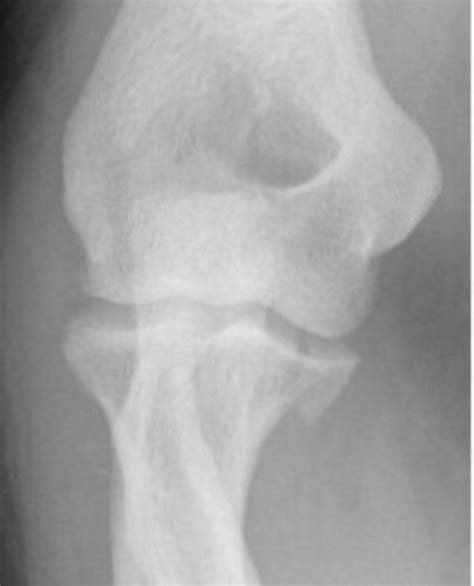 Coronoid Process Fracture Post Orthobullets