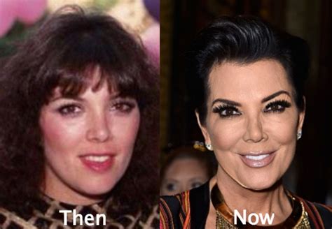 Kris Jenner Plastic Surgery On Hand Before And After