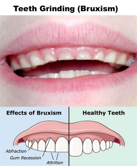 Nighttime Teeth Grinding Bruxism In Children The Kids Dentist