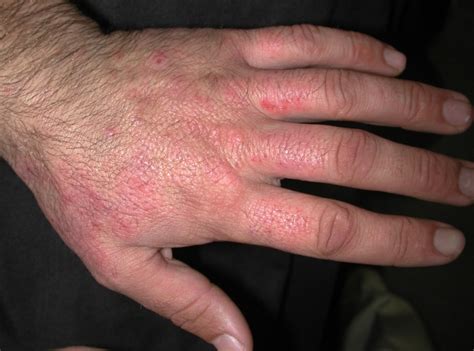 Irritant Contact Dermatitis Icd Acd