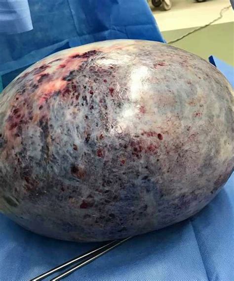 And there are a lot of smaller cysts every month that go along for the ride. An enormous 40 pound (18 kg) ovarian cyst - MEDizzy Journal