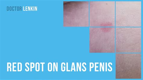 🙁 Red Spot On Glans Penis Youtube