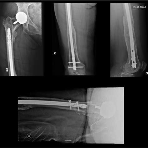 Postoperative Ap And Lateral Radiographs Of The Right Hip And Femur
