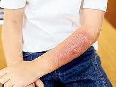 Scars that develop from a superficial burn can vary in degrees of severity. How to Get Rid of Burn Scars