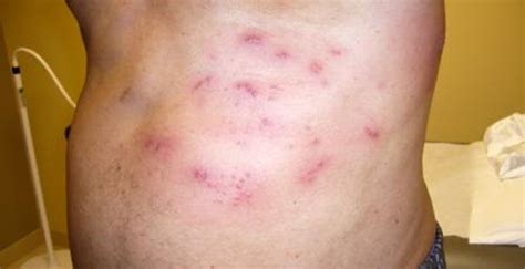 Type Diabetic Male Experiencing Painful Rash Journal Of Urgent Care Medicine