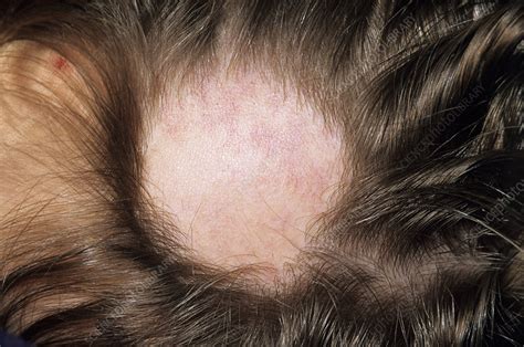 Alopecia Stock Image M1080620 Science Photo Library