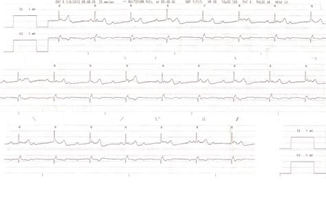 In a third degree heart block, the p waves are married to the qrs complexes. Dr. Smith's ECG Blog: Intermittent third degree heart ...