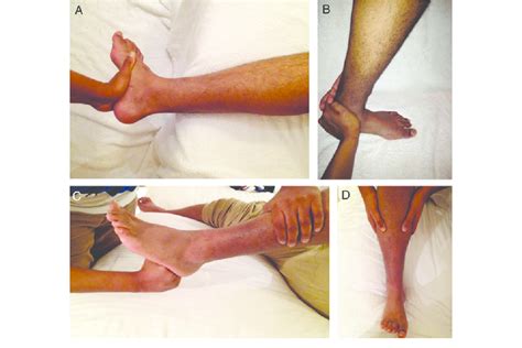 Tendinitis, bone spurs, plantar fasciitis and stress fractures are just a few causes of heel pain. (A) External rotation test. (B) Dorsiflexion compression ...