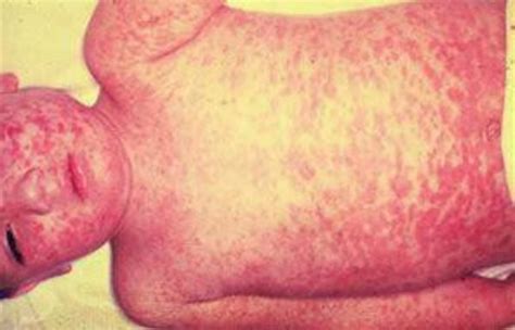 County Health Officials Gear Up For Potential Measles Outbreak News