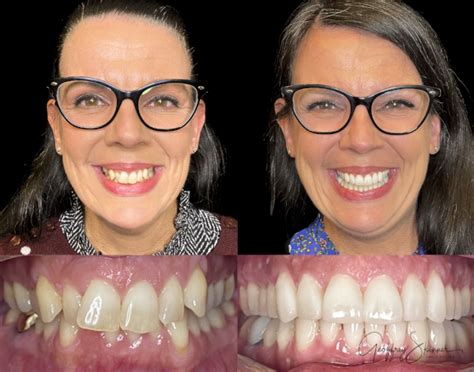 Invisalign Before And After Dental Treatment Before And After Photos