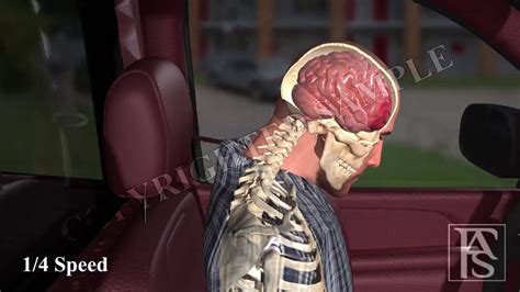 Rear End Collision Brain Injury Youtube