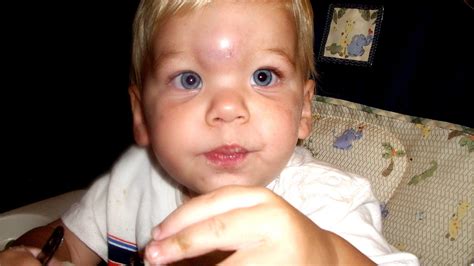Head Injuries In Infants Injury Injury Choices