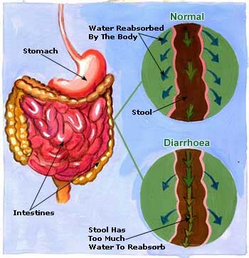 The spores can survive when rice is cooked. Diarrhea - causes, symptoms and treatment | Health Care ...