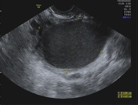 Ovarian Cyst Observed On Transvaginal Ultrasound In A Year Old Hot Sex Picture