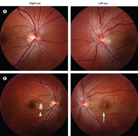 Diagnosis And Clinical Features Of Common Optic Neuropathies The