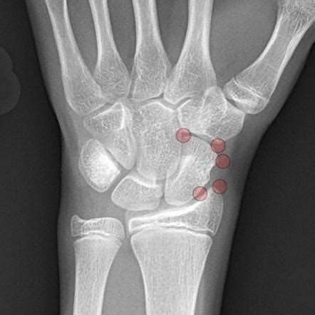 Accessory Ossicles Of The Wrist Radiology Reference Article Radiopaedia Org