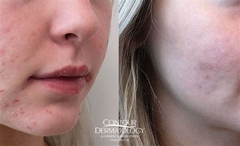 Acne Scars Treatment Before And After Photos