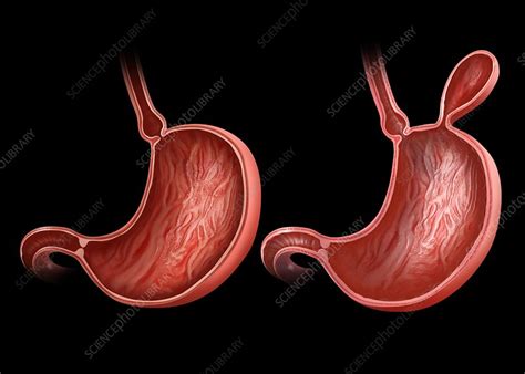 Stomach With And Without Hernia Stock Image F0122318 Science