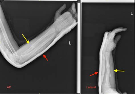 Cureus Ulnar Nerve Palsy In Both Bone Forearm Fracture In A Pediatric
