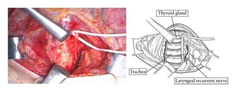 Dissection Of Left Cervical Paraesophageal Lymph Nodes Left Laryngeal