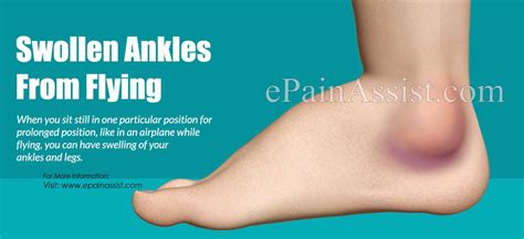 Swollen Ankles From Flying Causes Treatment Prevention 2022