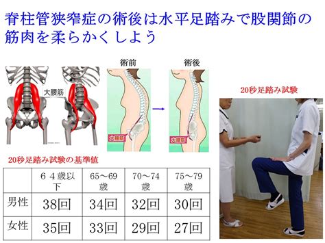 背骨の変形を矯正する手術後は水平足踏みで股関節の筋肉を ...