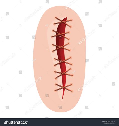 9851 Surgical Incision 이미지 스톡 사진 및 벡터 Shutterstock