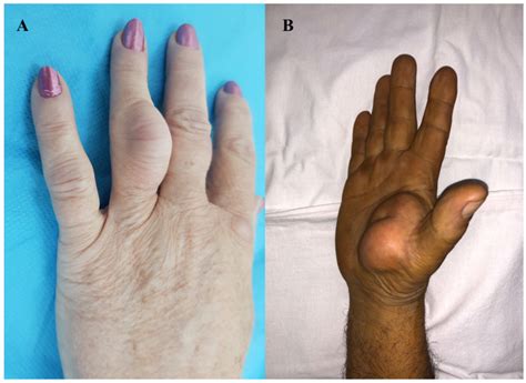 Malignant Tumors Of The Hand