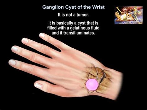 Ganglion Cyst Of The Wrist Everything You Need To Know Dr Nabil Ebraheim Youtube