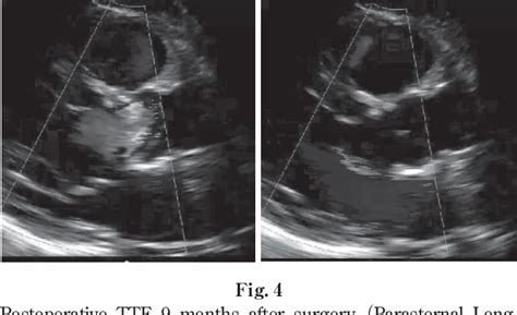Figure 4 From Bicuspidization Of The Unicuspid Aortic Valve By