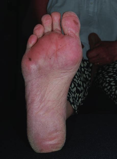 Mild Dryness And Brownish Spots On Soles Of Feet Download Scientific