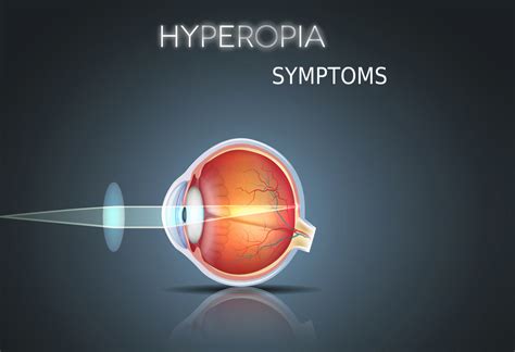 Hyperopia Farsightedness Causes Symptoms Diagnosis Treatment