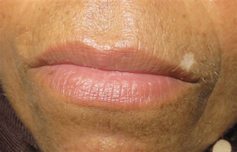 Vitiligo‐like Well‐demarcated Depigmented Macule On The Upper Lip