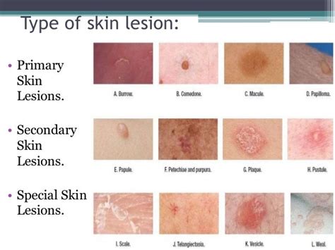 types of skin lesions top 10 most aggressive types of cancer skin porn sex picture