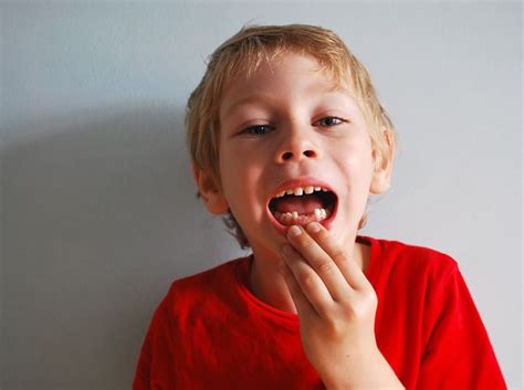 What To Do Child Is Missing Permanent Teeth Congenitally Missing Teeth
