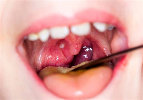 Can Wisdom Teeth Cause Sore Throat Boston Dentist Congress Dental