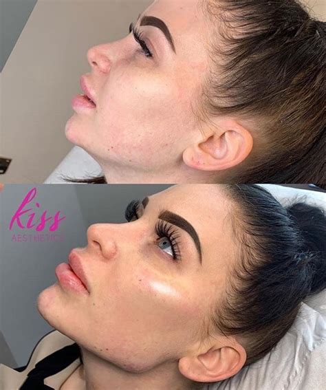 The Jawline Experts Right Here Kissaesthetics ・・・ Our Signature Jawlinechin In All Its
